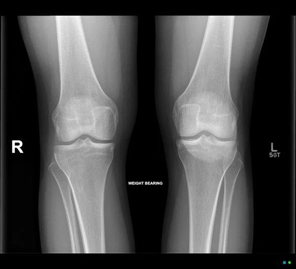 El que necessites saber sobre la bursitis del genoll