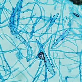Tinea capitis: årsaker, symptomer og behandling
