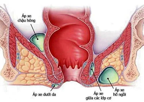 Quines són les complicacions de les hemorroides?