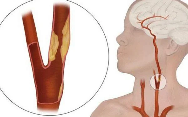 Arterias: vasos sanguíneos que levan nutrientes ao corpo