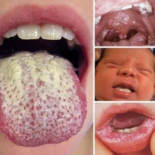 Candidiasis bucal (fungo da lingua): Causas, recoñecemento e tratamento