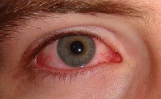 Allerginen sidekalvotulehdus: ymmärsitkö oikein?