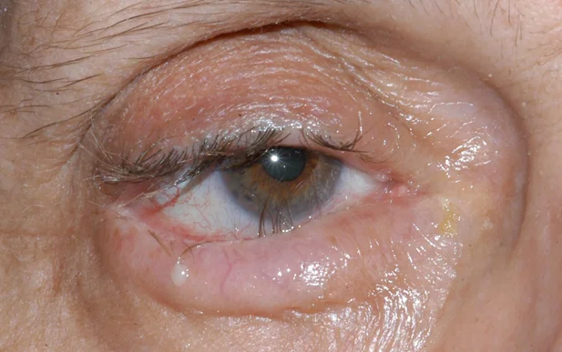 Tracoma: síntomas, causas e tratamento