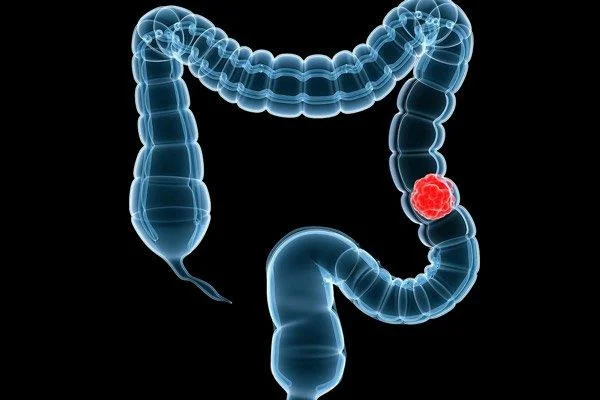 Dolor abdominal, a què s'ha de parar atenció per no perdre's causes perilloses?