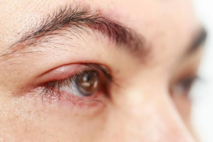 Ulls inflats: què cal saber i com prevenir-ho
