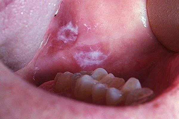 Cieto aukslēju vēzis: simptomi, diagnostika un ārstēšana