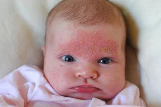 Causas, síntomas e tratamentos da dermatite seborreica
