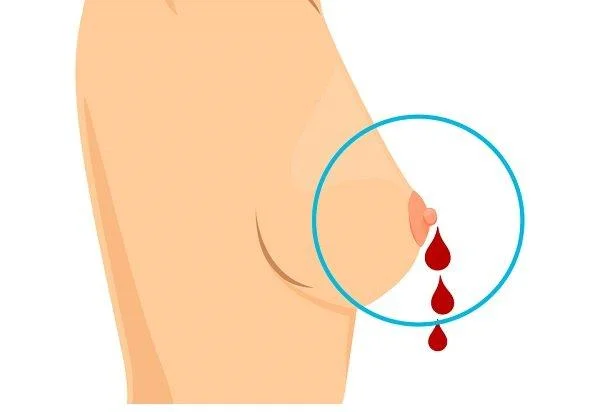 Como recoñecer o cancro de mama: información importante para as mulleres