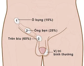 Malalties testiculars de les quals els homes han de tenir cura