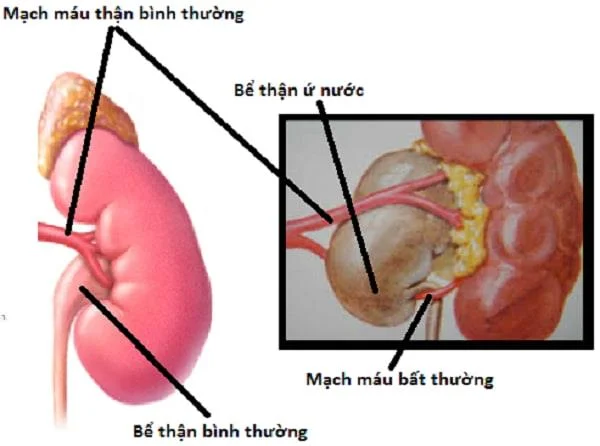 Que é a obstrución ureteral e como che molesta?