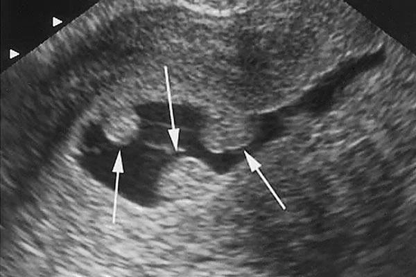 Pòlips uterins: el que has de saber!