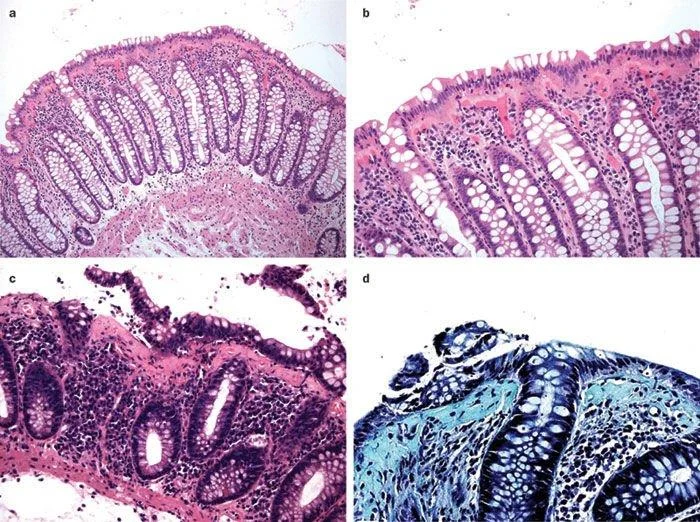 Mikroskopisk kolitt: Årsaker, diagnose og behandling
