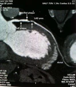 Koronar angiografi: Är det farligt?