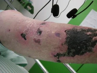 Vaskulær forkalkning og hudnekrose (Calciphylaxis)