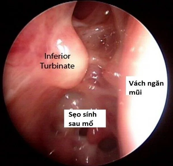 Rinoplastia: todo o que debes saber