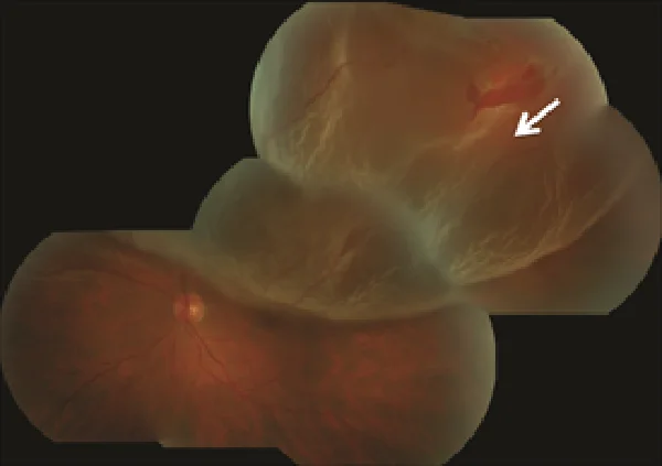 Estrutura da retina e enfermidades comúns da retina