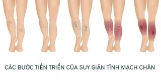 Aprende sobre as varices, as causas e o tratamento
