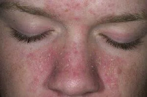 Årsager, symptomer og behandlinger af seborrheic dermatitis