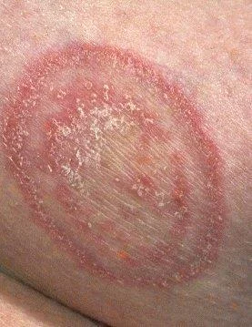 Tinea capitis: causas, síntomas e tratamento