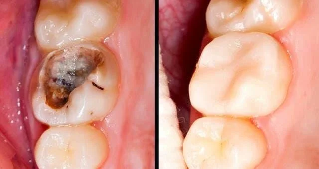 Inflamación da pulpa dental: causas, diagnóstico e tratamento