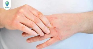 Comprensión correcta da causa da dermatite atópica